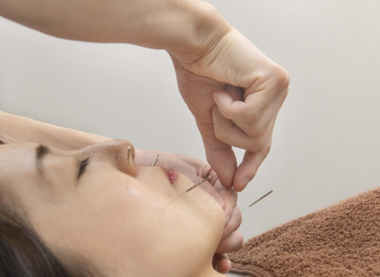 安全性の高い鍼施術