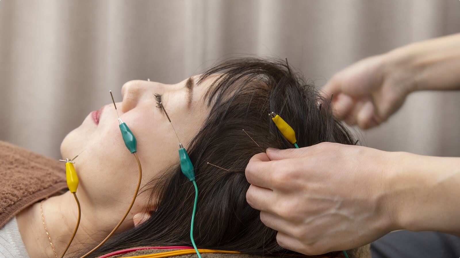 美容鍼・超リフトアップ