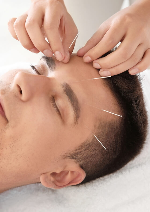 美容鍼