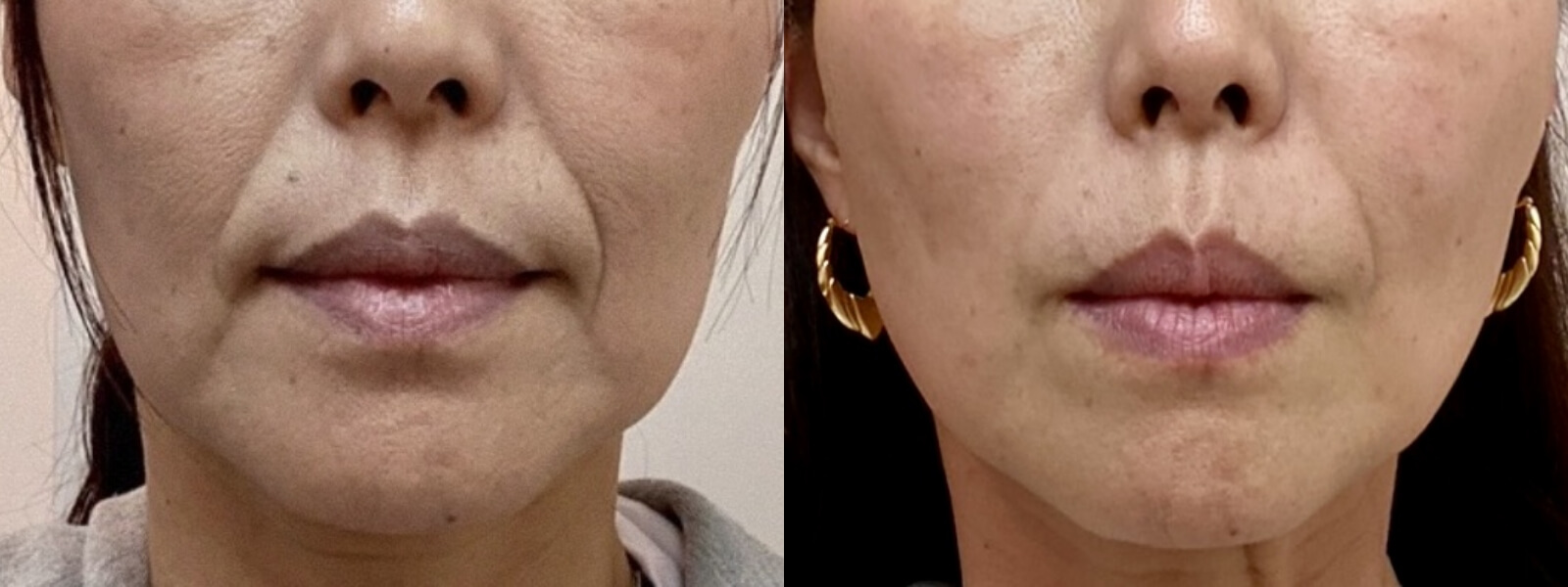 超リフトアップの効果