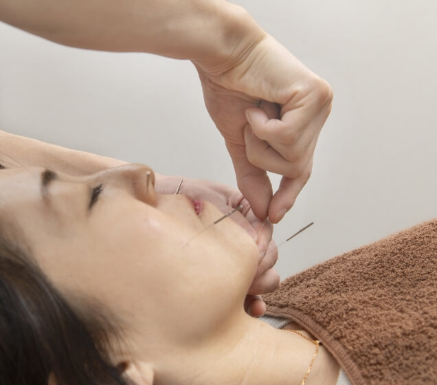 美容鍼